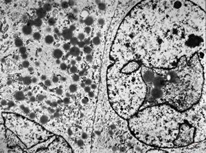 M,64y. | liposarcoma v.s.